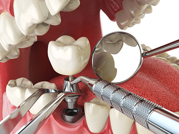 Best Knocked-Out Tooth Emergency  in Newport, VT